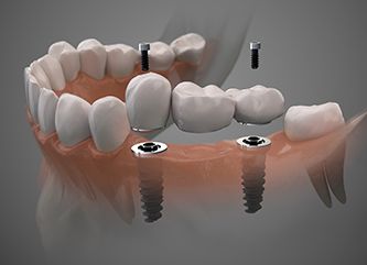 Woman smiling with a dental bridge in Dix Mills