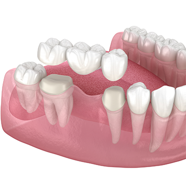 Illustration of dental bridge being attached to teeth in the lower arch