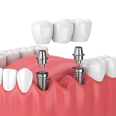 Illustration of dental bridge being attached to dental implants