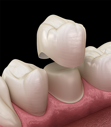 Illustration of dental crown in Dix Hills