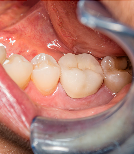 Close-up of teeth in lower arch