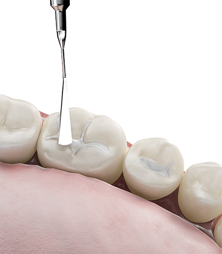 Applying tooth-colored fillings to teeth
