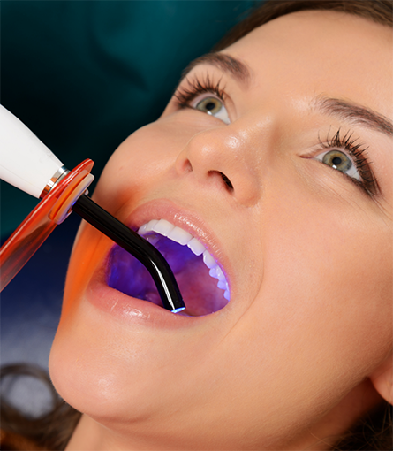 Woman opening mouth for curing light during filling process