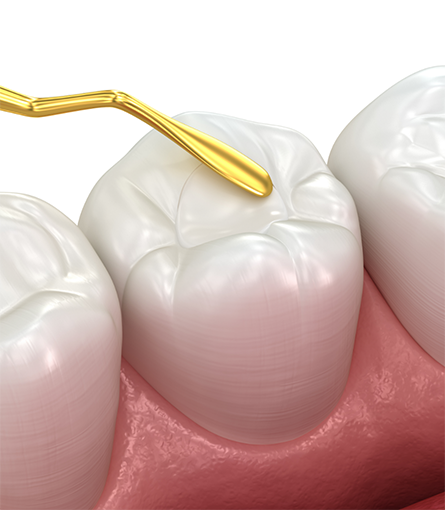 Illustration of dental sealant in Dix Hills being applied to a tooth