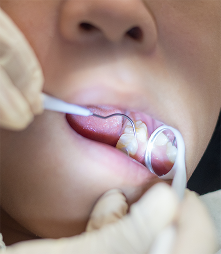 Using dental mirror and explorer tool to examine teeth