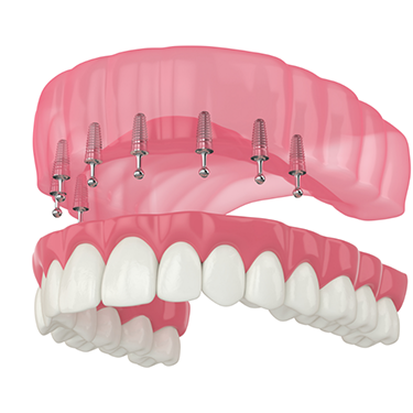 Illustration of dentures being attached to dental implants in the upper arch