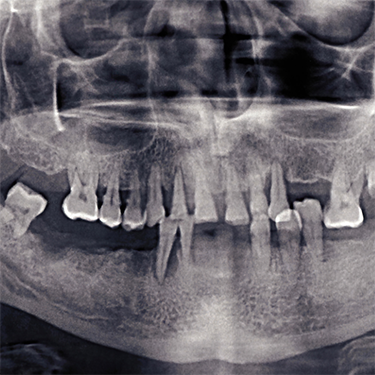X-ray of mouth with missing teeth
