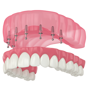 Illustration of full denture being attached to dental implants in upper jaw