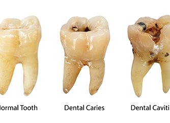 Model of a tooth-colored filling