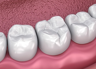 Dental light hardening composite resin