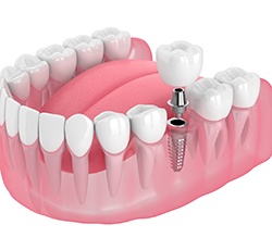 Illustration of a single dental implant