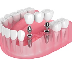 Illustration of an implant bridge