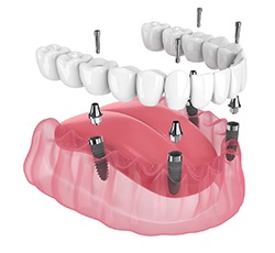Illustration of an implant denture