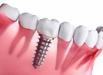 Diagram showing dental implants in Dix Hills