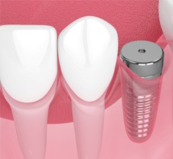 Digital illustration of dental implant