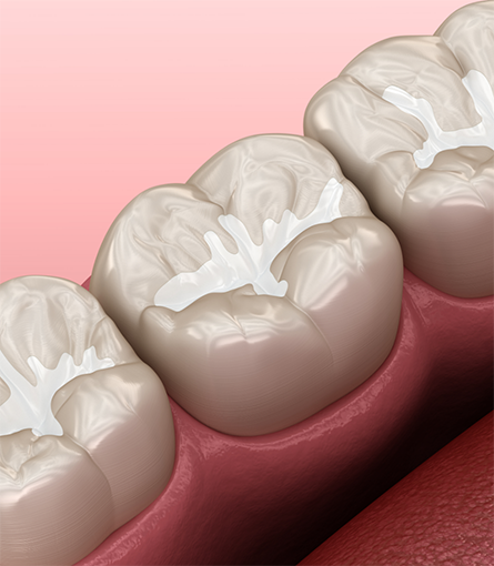 Illustration of teeth with tooth-colored fillings