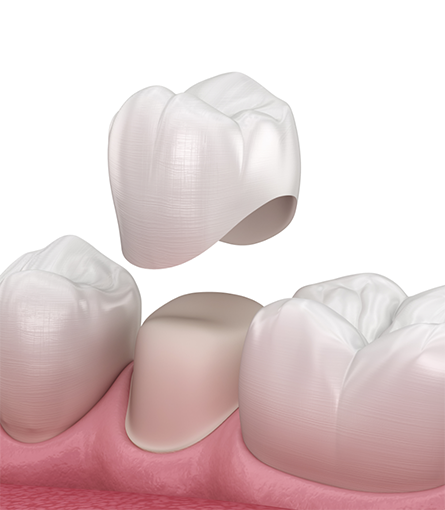 Illustration of dental crown being attached to a tooth