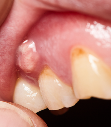 Close up of abscess on gums