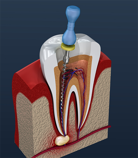 Illustration of root canal treatment