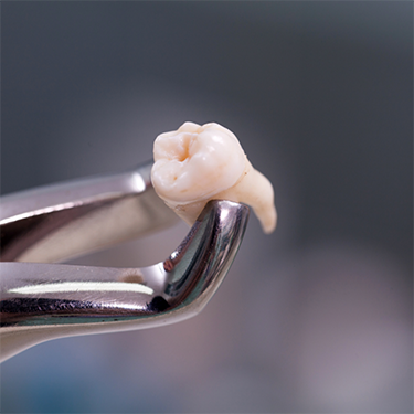 Forceps holding an extracted tooth