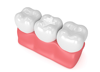 Model of a dental sealant on a molar.