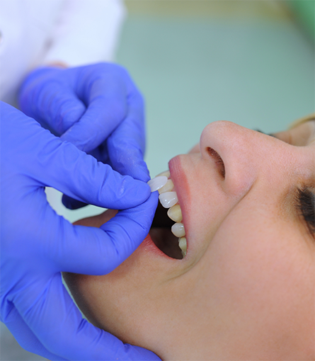 Gloved hands placing veneers on patient's teeth