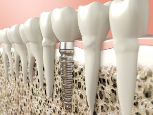 An illustration of dental implants.