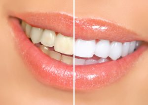 before and after picture teeth whitening