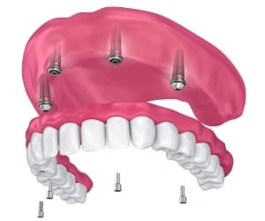 Image of an upper implant denture