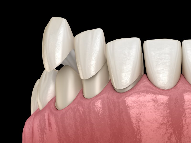 Illustration of replacing veneers